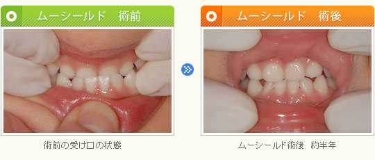 ムーシールド術後　約半年