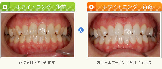 オパールエッセンス使用　１ヶ月後