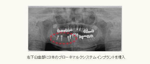 右下臼歯部に３本のブローネマルクシステムインプラントを埋入