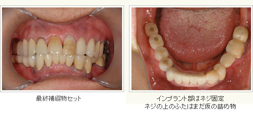 最終補綴物セット　インプラント部はネジ固定式