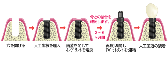 インプラント　２回法