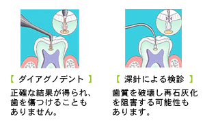 虫歯検査器　ダイアグノデント