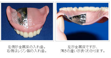 金属床義歯