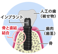 インプラント