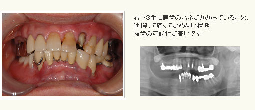 右下３番に義歯のバネがかかっているため動揺して痛くて噛めない状態