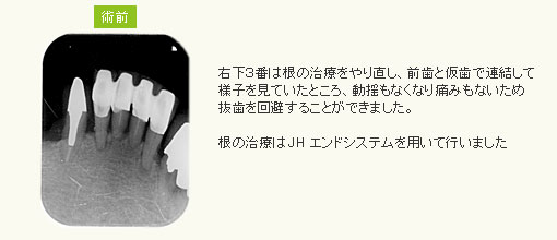 右下３番は根の治療をやり直し前歯と仮歯で連結して様子を見ていたところ動揺もなくなり痛みもないため抜歯を回避することができました