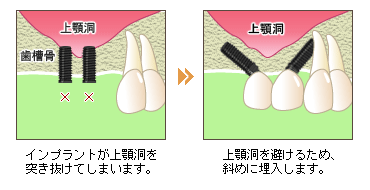 傾斜埋入法