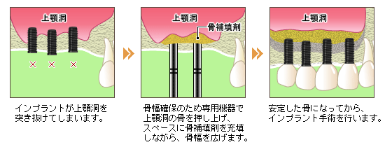 ソケットリフト法