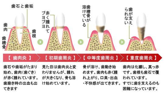 歯周病の進行図